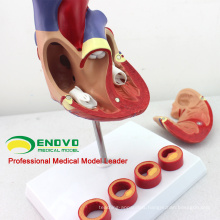 HEART05(12481) Life-size Human Heart Anatomy in 2 part with 4 Pieces Thrombosis Cross Section ,Anatomy Models > Heart Models